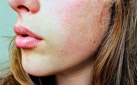 Аллергия на косметику: какие причины и что с этим делать